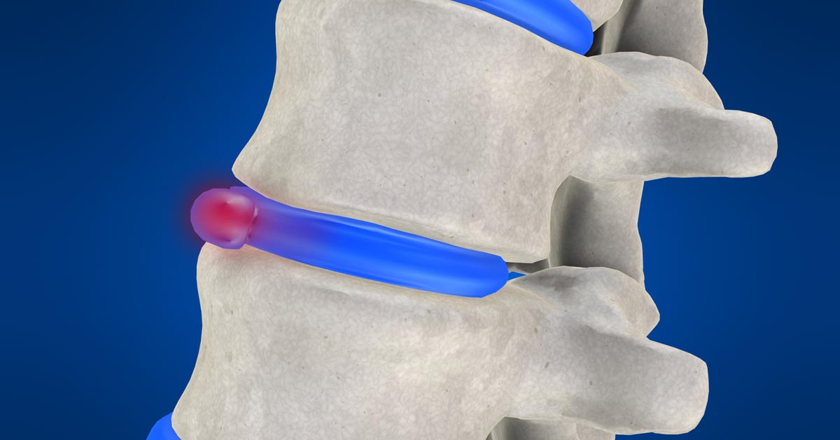 Depew non-surgical disc herniation treatment