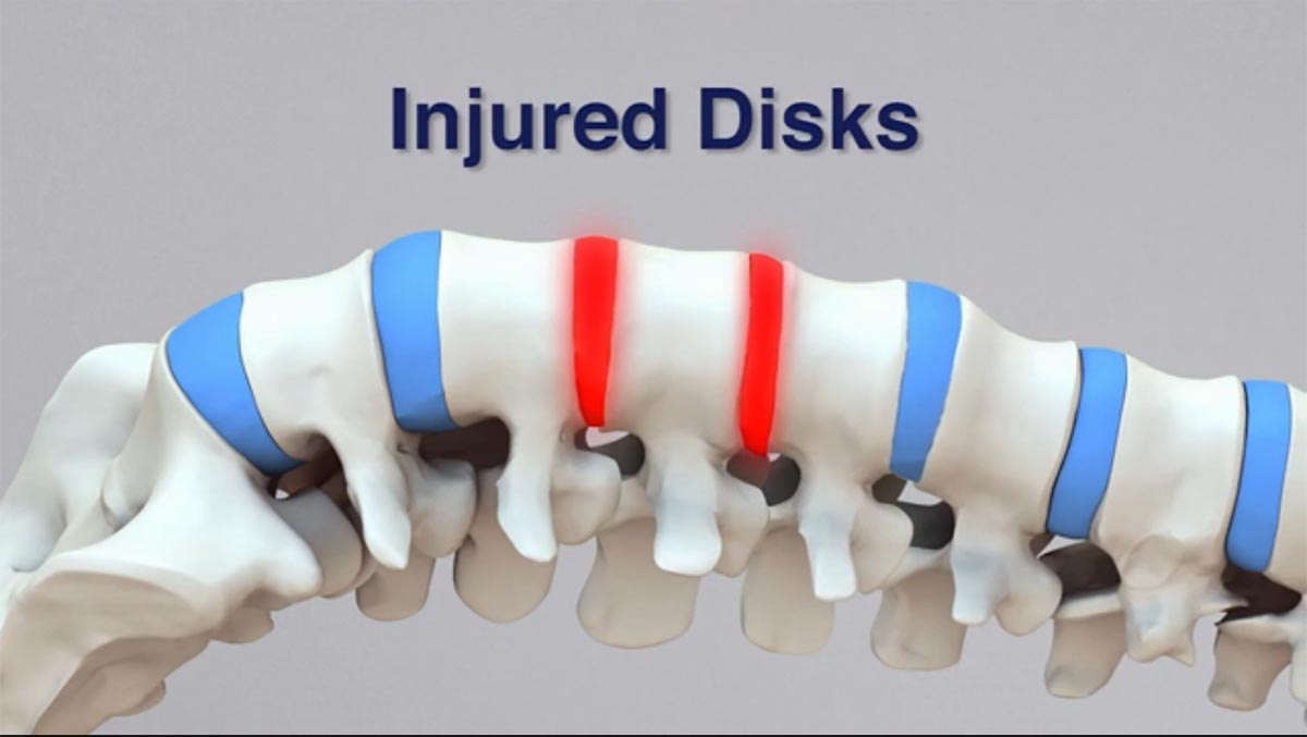 Lancaster non-surgical spinal decompression